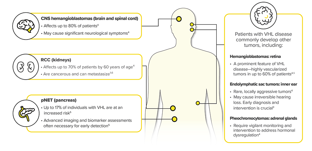 Infographic Showing Potential Sites of Tumor Growth in VHL Disease