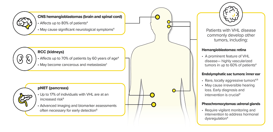 Infographic Showing Potential Sites of Tumor Growth in VHL Disease